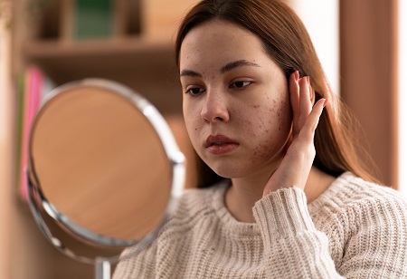 Ascletis Initiates Phase III Trial for ASC40 in Acne Vulgaris
