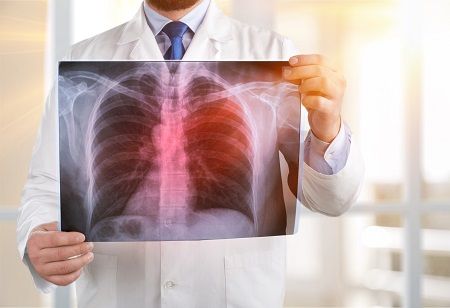 New MRI Dye Could Map Tiny Lung Tumors and Hidden Metastases India Pharma Outlook
