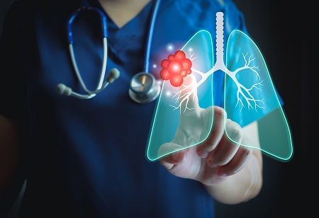  Early FDA Approval Gives GSK a Big Lung Cancer Breakthrough, India Pharma Outlook