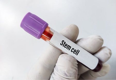  One-Time Cell Therapy Shows Promise in Controlling HIV Infection