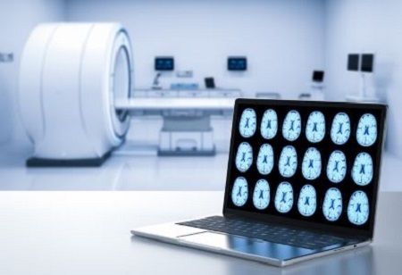 Trontinemab Takes Center Stage as Roche Unveils Alzheimer's Breakthrough