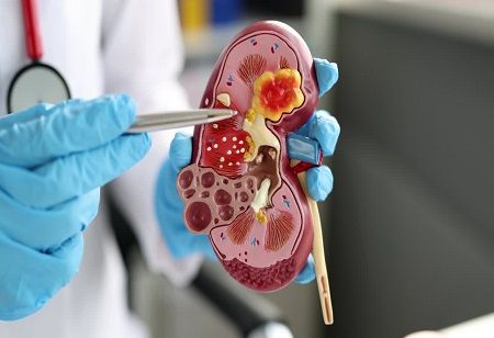 Merck-Eisai Kidney Cancer Drug Combo Hits Key Trial Milestone  Merck, Eisai, kidney cancer