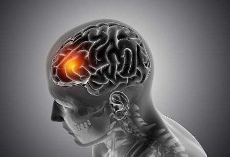  Ionis Wins FDA Approval For First Alexander Disease Treatment India Pharma Outlook