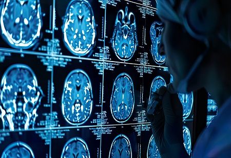  16.9 Million By 2036: Why India Needs A Dementia Care Ecosystem Now India Pharma Outlook