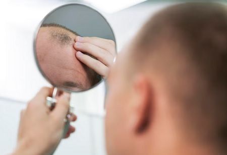  male hair loss treatment, India Pharma Outlook