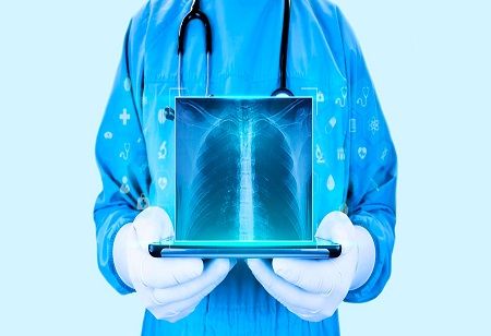  At NAPCON 2026, AI Emerges as TB & Lung Cancer Ally India Pharma Outlook